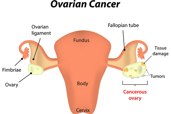 5 Steps To Prevent Ovarian Cancer