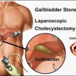 What are the five things you need to know when having GALL BLADDER STONE?