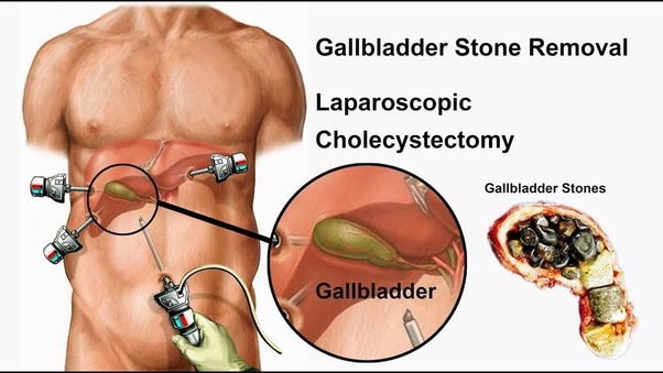 GALL BLADDER STONE | Gallbladder Specialist In Chandigarh 
