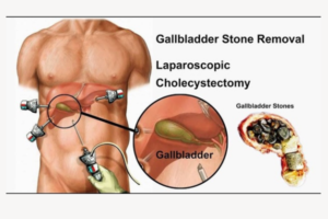 laparoscopic surgeon in chandigarh