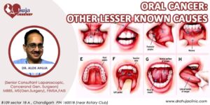 Oral Cancer and Its Causes