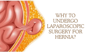 Why to Undergo Laparoscopic Surgery for Hernia?