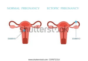 FALLOPIAN TUBES AND ECTOPIC PREGNANCY