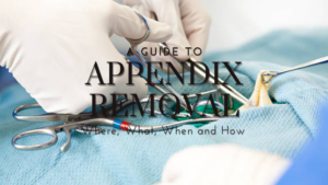 A Guide to Appendix Removal: Where, What, When and How