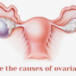 What are the causes of ovarian cysts?