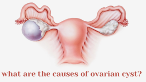 What are the causes of ovarian cysts?