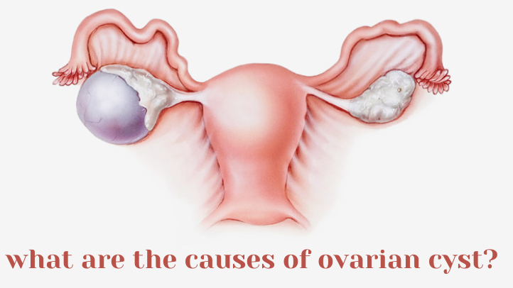 What Are The Causes Of Ovarian Cysts?