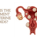 What Is The Treatment For Uterine Fibroids?