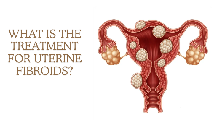 What Is The Treatment For Uterine Fibroids?