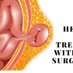 Can Hernia Be Treated Without Surgery