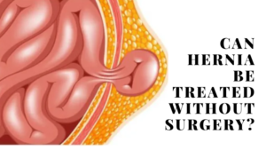 Can Hernia Be Treated Without Surgery