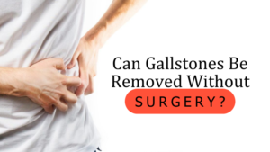 Can Gallstones be removed without surgery?