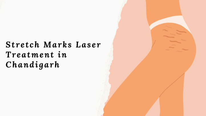 Stretch Marks Laser Treatment in Chandigarh