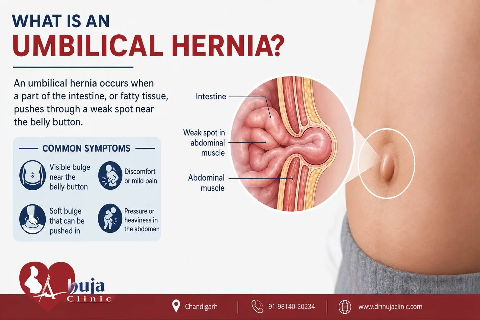 Umbilical Hernia: Symptoms, Causes