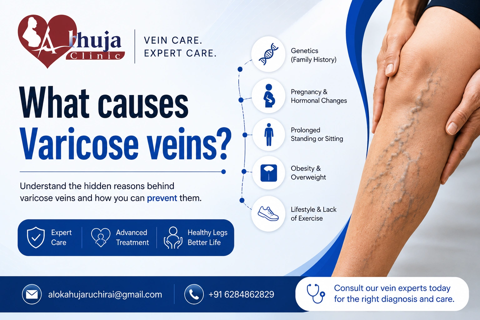 What causes Varicose veins?